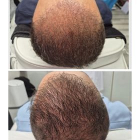 Prp hair treatment