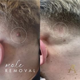 Mole removal