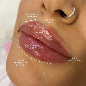 Lip filler