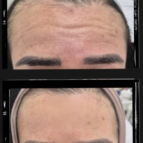 Botox