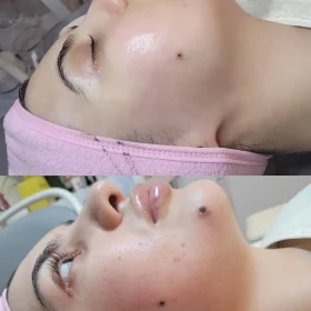 deepclean facial and dermaplain